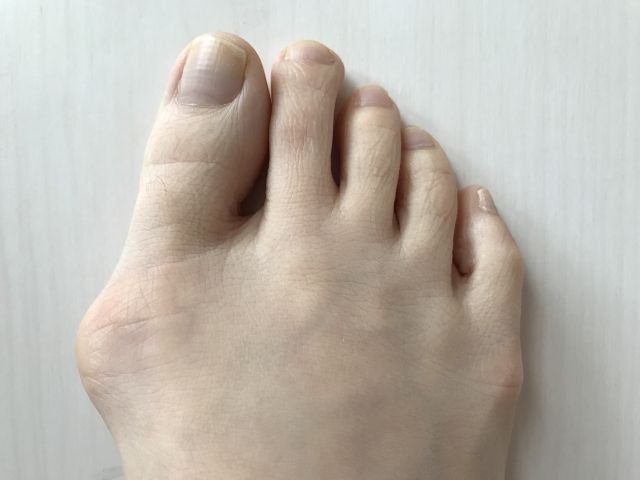 親指付け根がズキズキ痛い 外反母趾の原因 治し方や靴選びのポイント 不動産コラムサイト いえらぶコラム