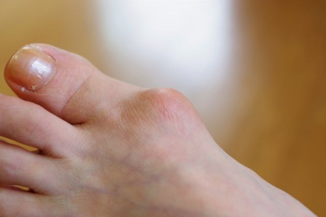 親指付け根がズキズキ痛い 外反母趾の原因 治し方や靴選びのポイント 不動産コラムサイト いえらぶコラム